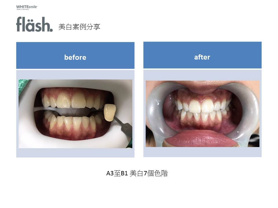 誠楷牙醫公開的 FLASH 光照美白真人病例治療前照片