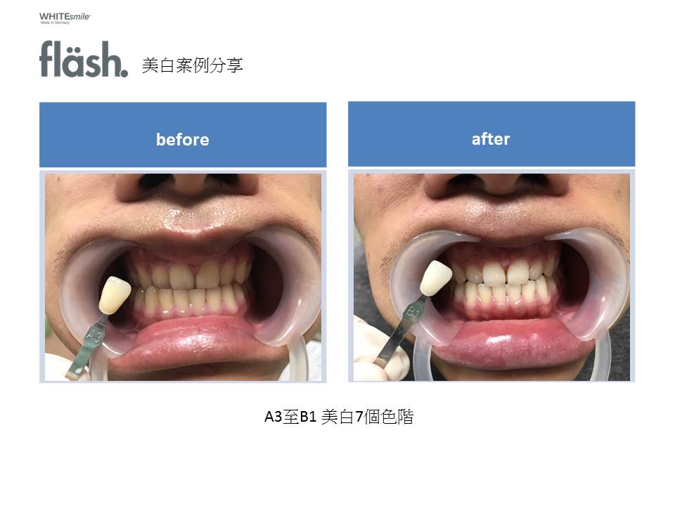 誠楷牙醫公開的 FLASH 光照美白真人病例治療後照片