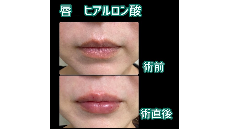 日本東京 Royal Clinic 公開的玻尿酸豐唇術前與術直後案例,照片已下載至本地