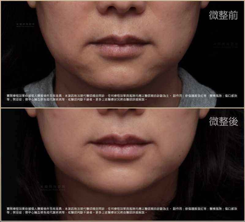 診所公開的玻尿酸豐唇術前與微整後實際案例,原圖已下載至本地素材