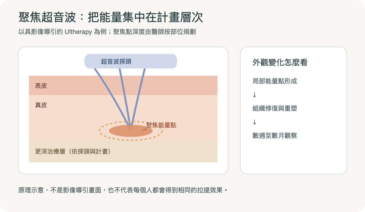 聚焦超音波形成深度焦點示意