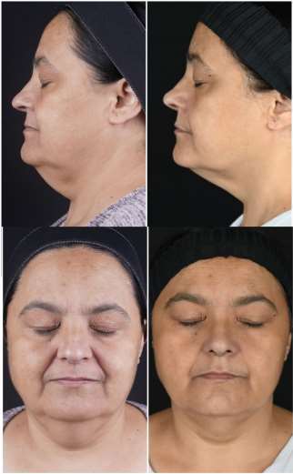 1470nm Endolifting臨床研究病例:作者標示為治療前與60日後的下顎、頸部照片,圖4