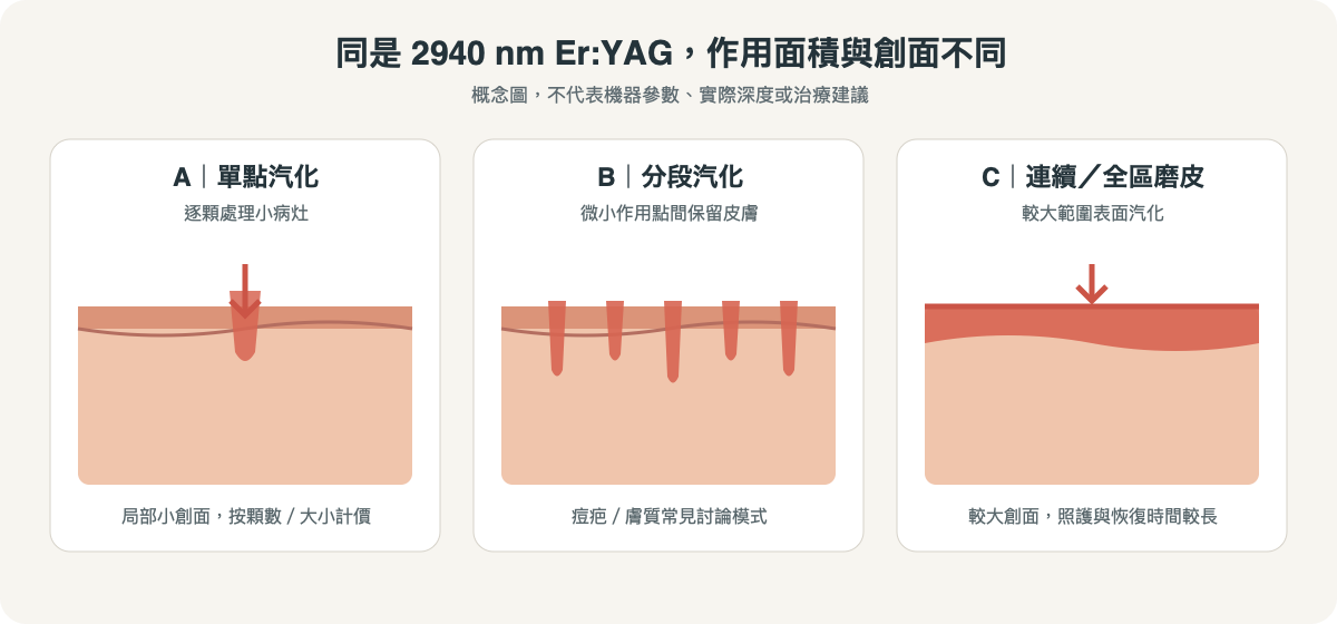 2940 nm Er:YAG 單點、分段與全區磨皮的作用範圍示意