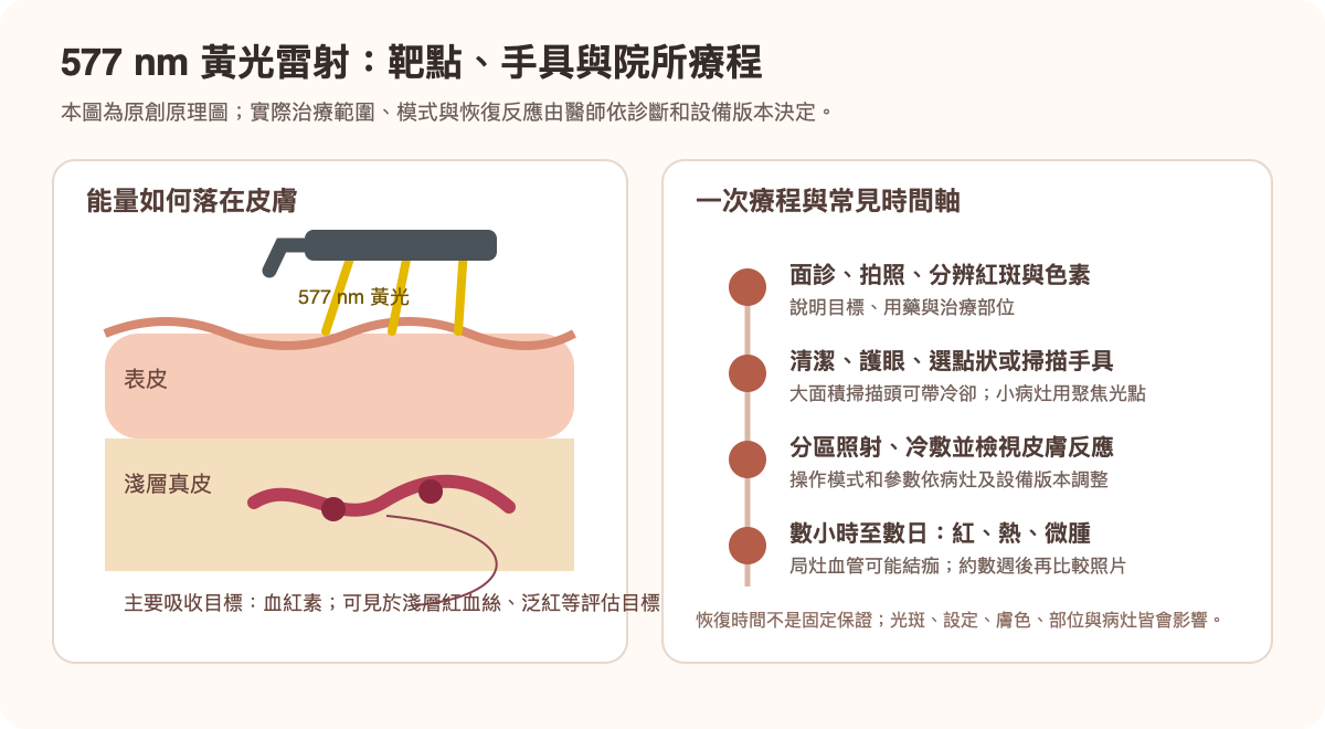 577nm黃光雷射的靶點、院所手具與療程時間軸原創圖