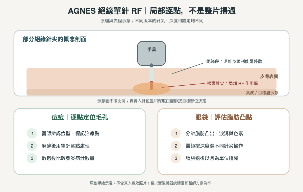 AGNES 絕緣單針射頻:針身絕緣段與針尖能量區,以及兩種不同部位操作流程