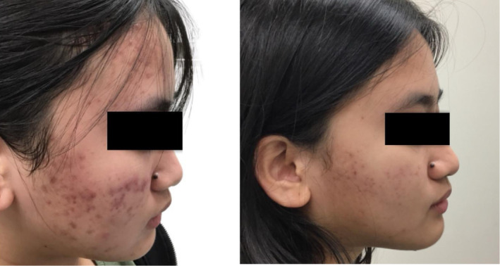 Neo Elite 1064nm痘痘雷射病例：17歲女性，研究圖7標示治療前與4次治療後，並合併外用及口服藥