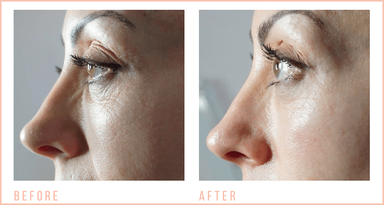Iconic Beautique Evesham 發布的 CACI 微電流療程前後實拍案例一;店家未標療程次數及拍攝間隔