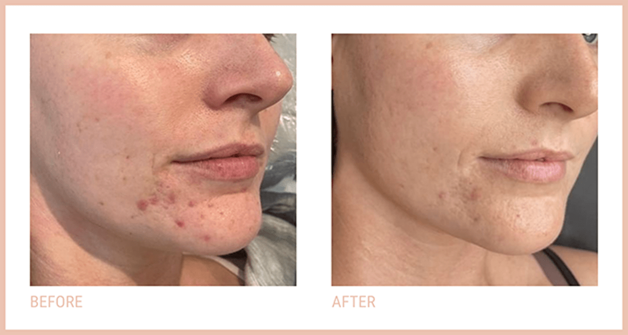 Iconic Beautique Evesham 發布的 CACI 微電流療程前後實拍案例二;店家未標療程次數及拍攝間隔