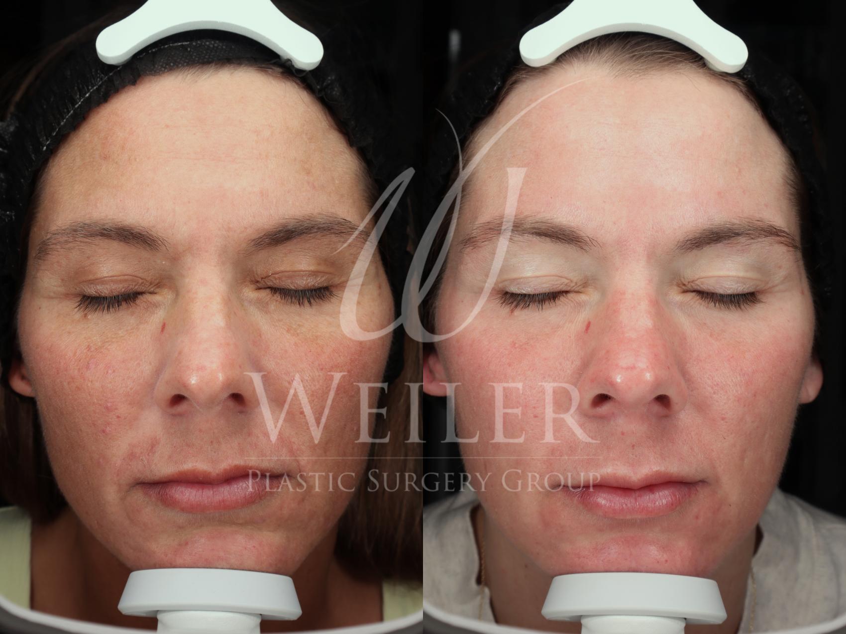 Weiler Plastic Surgery 公開病例1755:CoolPeel三次療程前後正面照