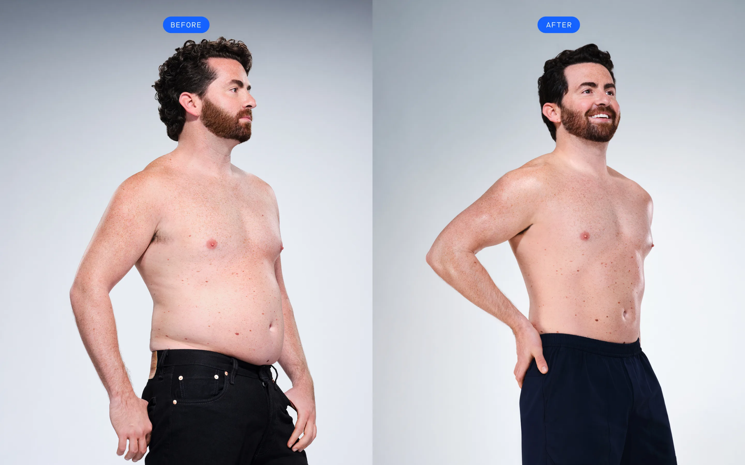 CoolSculpting 原廠公開 Ryan 個案:療程前後對照
