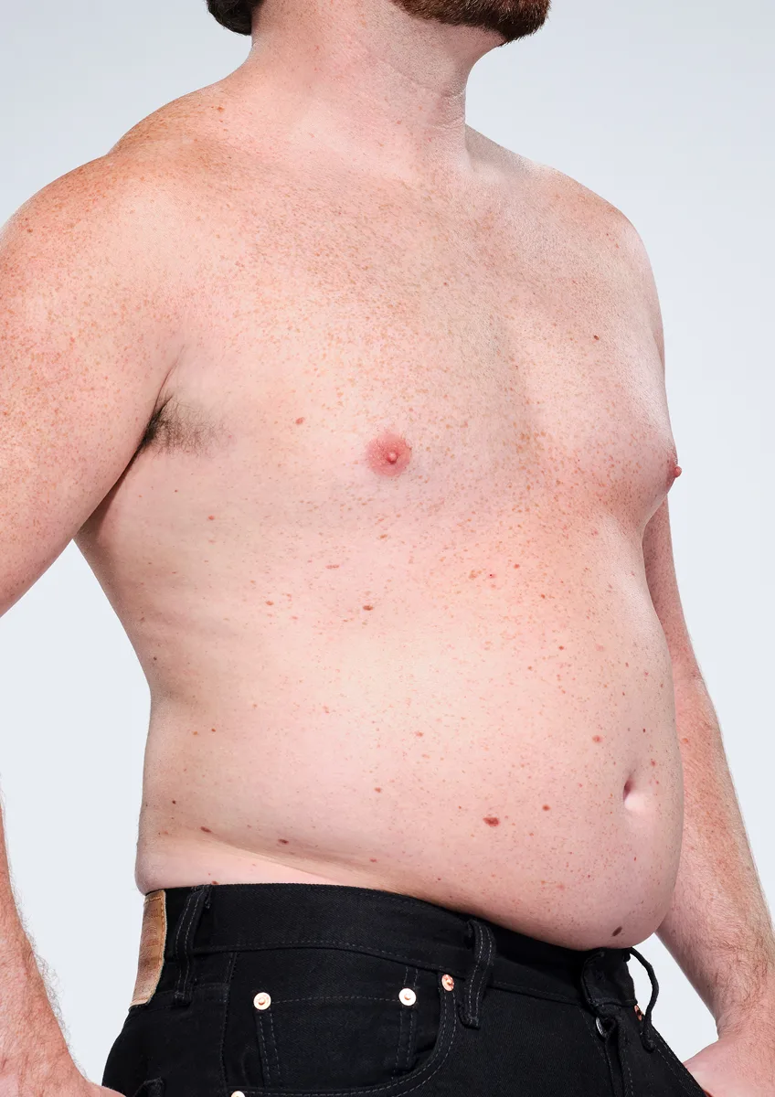 CoolSculpting Elite 官方患者 Ryan 腹部病例:治療前