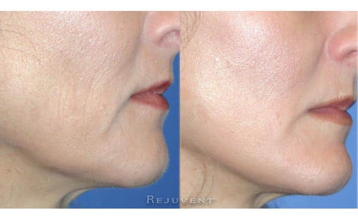 Rejuvent Medical Spa 公開的 Dermaplaning 病例前後照;院方標示為實際患者、未修圖
