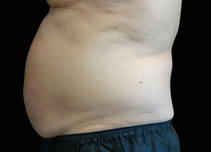 BTL 原廠病例圖庫中的男性腹部 EMSCULPT NEO 治療前照片