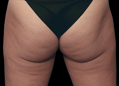 BTL EMTONE 療程前臀部案例照片;圖片來源標示 Marc Salzman, M.D.