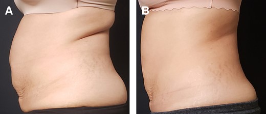 研究個案一：36 歲女性，Transform 療程前與完成療程系列六個月後的腹部及腰側側面照