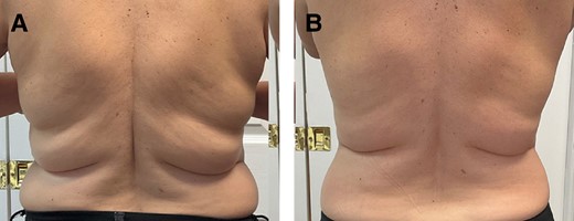 研究個案二：44 歲女性，Transform 療程前與完成療程系列六個月後的腰背及側腰照