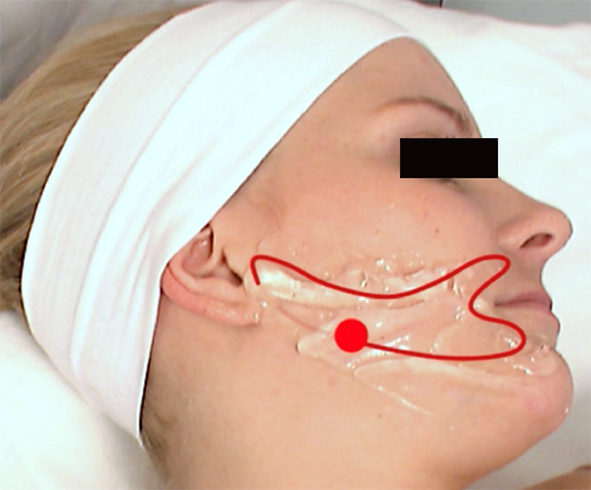 Exilis Ultra 下顎線療程示範:手具沿下顎輪廓慢速掃動