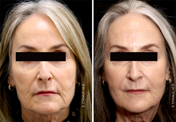 Exilis Ultra 臉部療程研究病例前後照片:第二次療程後三個月的正面對照