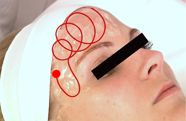 Exilis Ultra 臉部療程示範:治療師沿額頭向太陽穴以重疊圓弧操作手具
