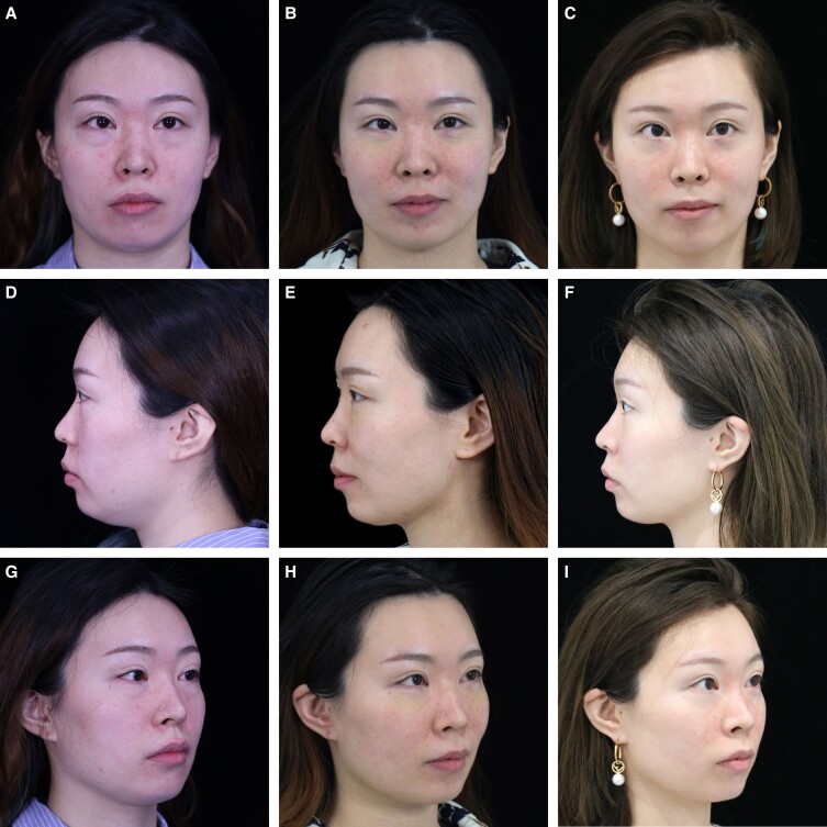 東亞FaceTite臨床病例圖2:31歲女性治療前、術後6個月和12個月的下巴與頸部外觀;單一研究病例
