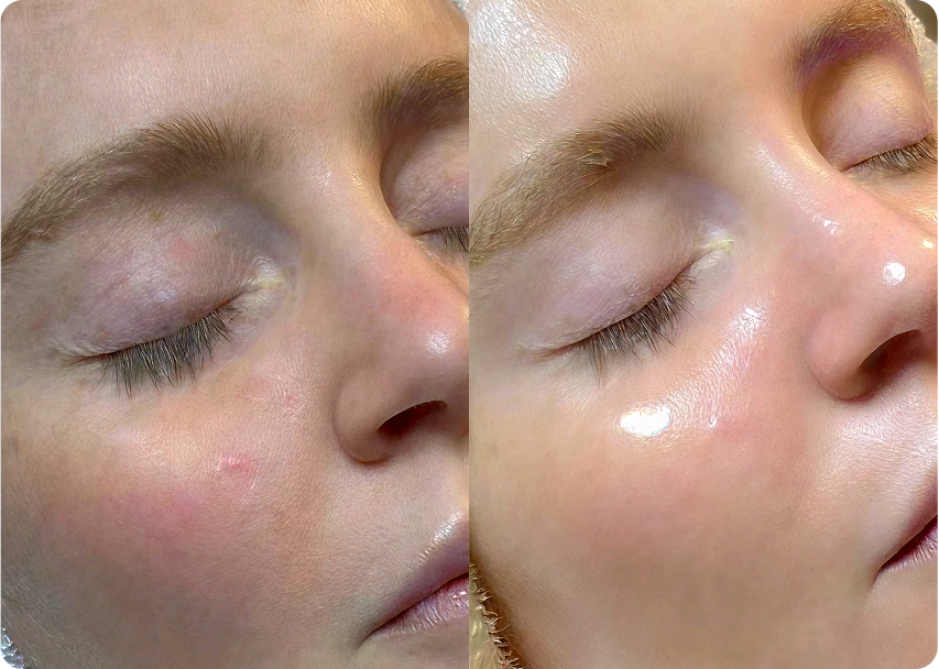 HydraFacial 原廠公開的單次 Deluxe 前後病例照，方案包括 ReGen booster 與紅光 LED