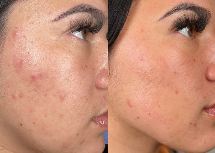 HydraFacial 原廠五次 Clarifying 系列療程前後照，另含 Murad Clarifying booster 與藍光 LED