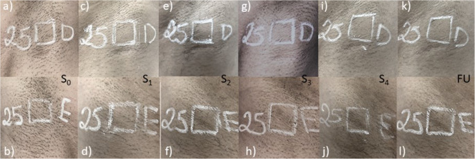 隨機左右側研究中的腋下毛髮追蹤照:上排 IPL、下排 810 nm 二極體雷射,S0 基準至 S4 第四次療程後與 FU 末次後 30 週