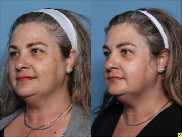 IPL 治療前後實際個案照片:WashU Medicine West County Plastic Surgeons 標示治療前後相隔八週,已存入專案