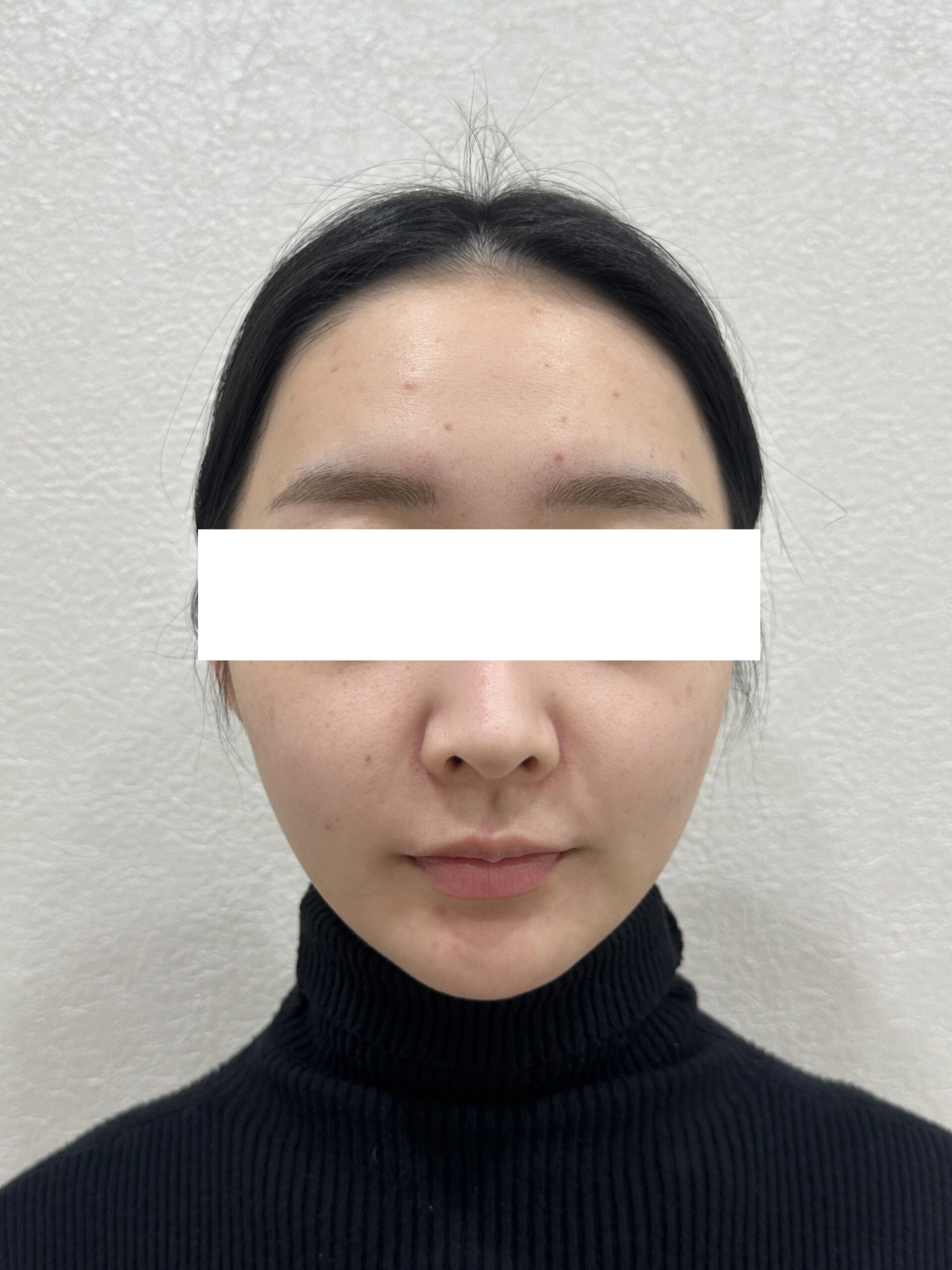 MiniFX＋Forma 治療後一個月個案照，診所公開案例