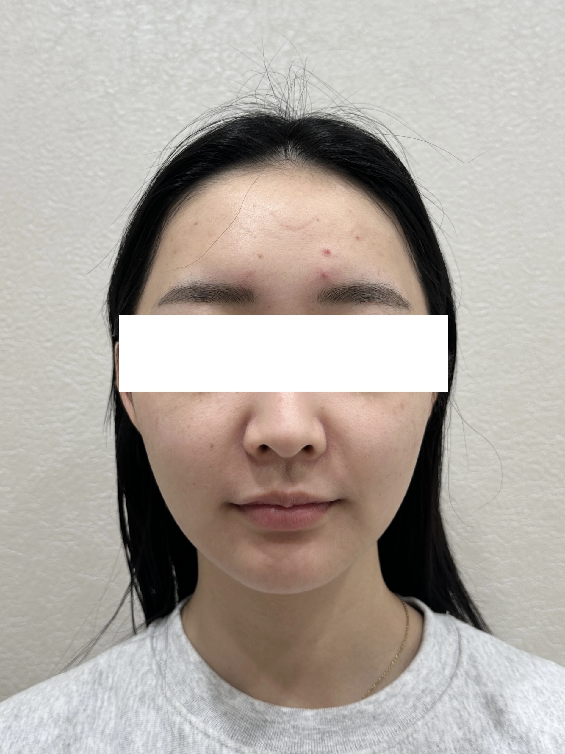MiniFX＋Forma 治療前個案照，診所公開案例