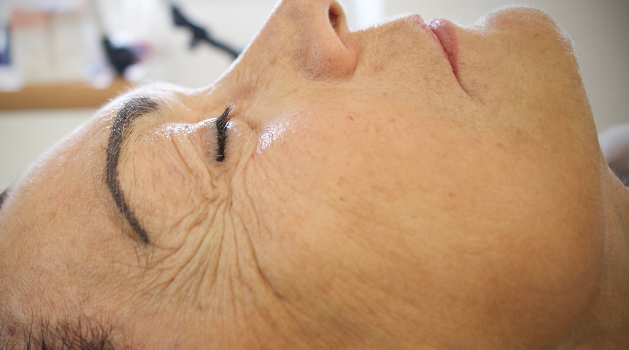JetPeel 原廠公開的個案眼周療程後實拍
