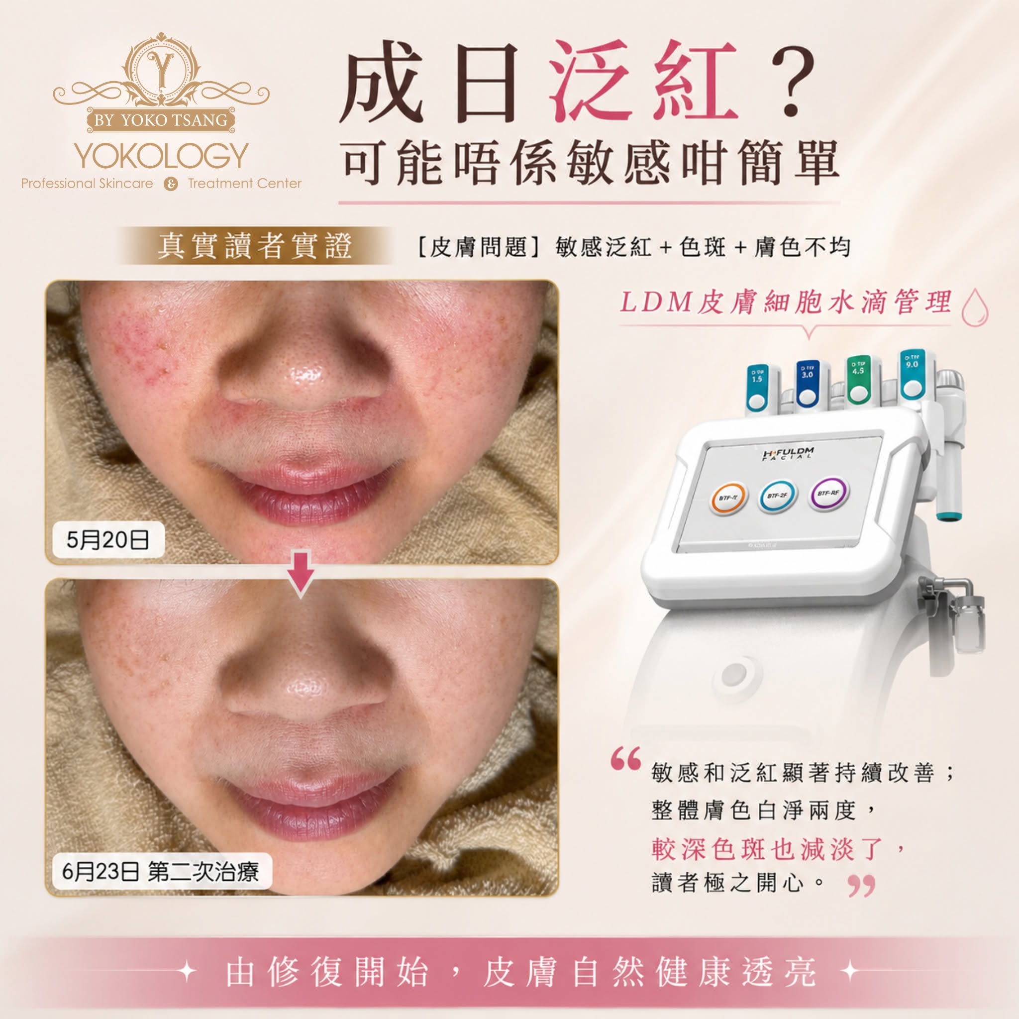 香港 YOKOLOGY Clinic 公布的 LDM 實拍案例:5 月 20 日療程前與 6 月 23 日第二次治療後