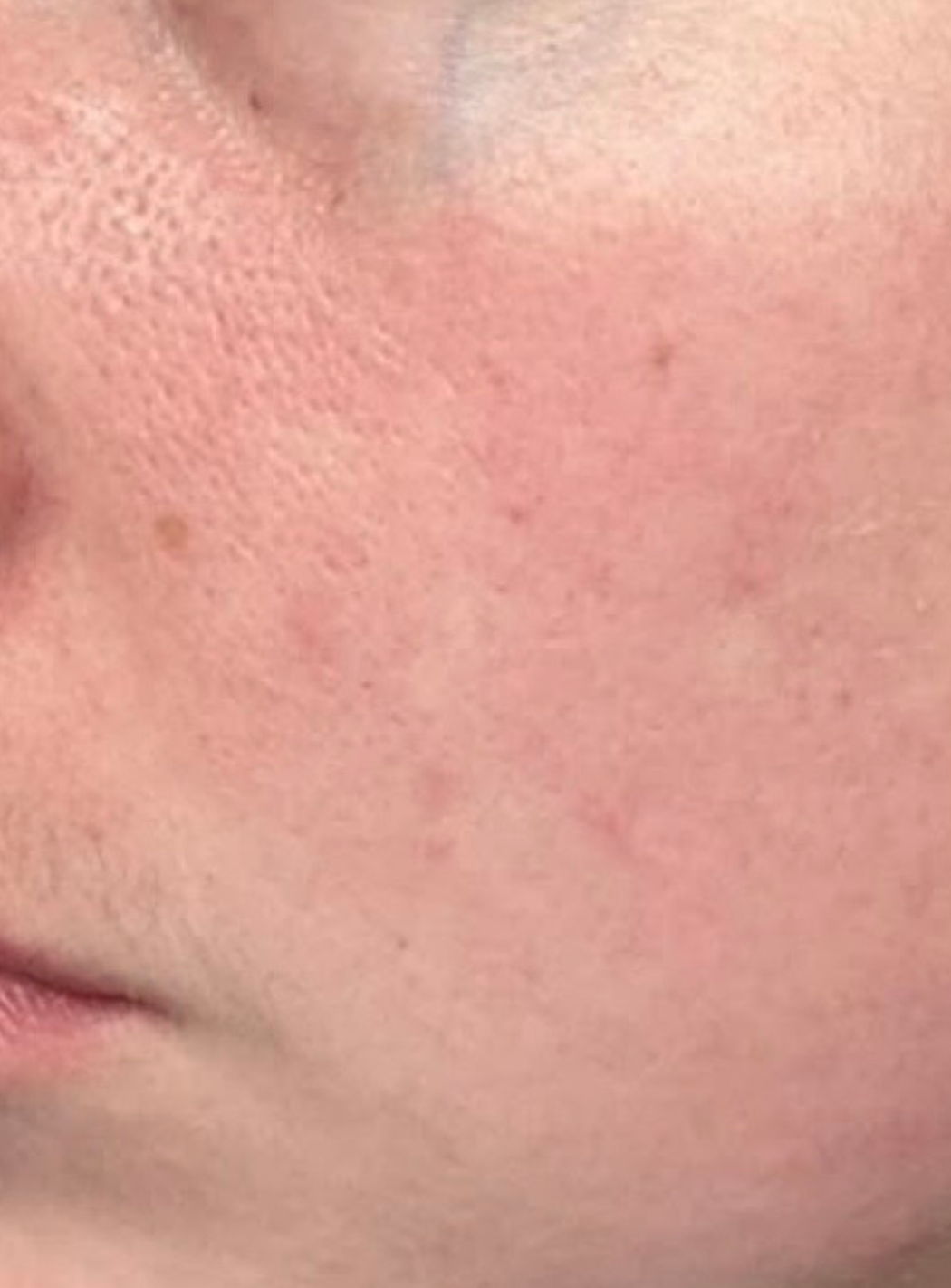 Dermalux Flex MD 原廠頁刊載的藍光痘痘案例療程後照片