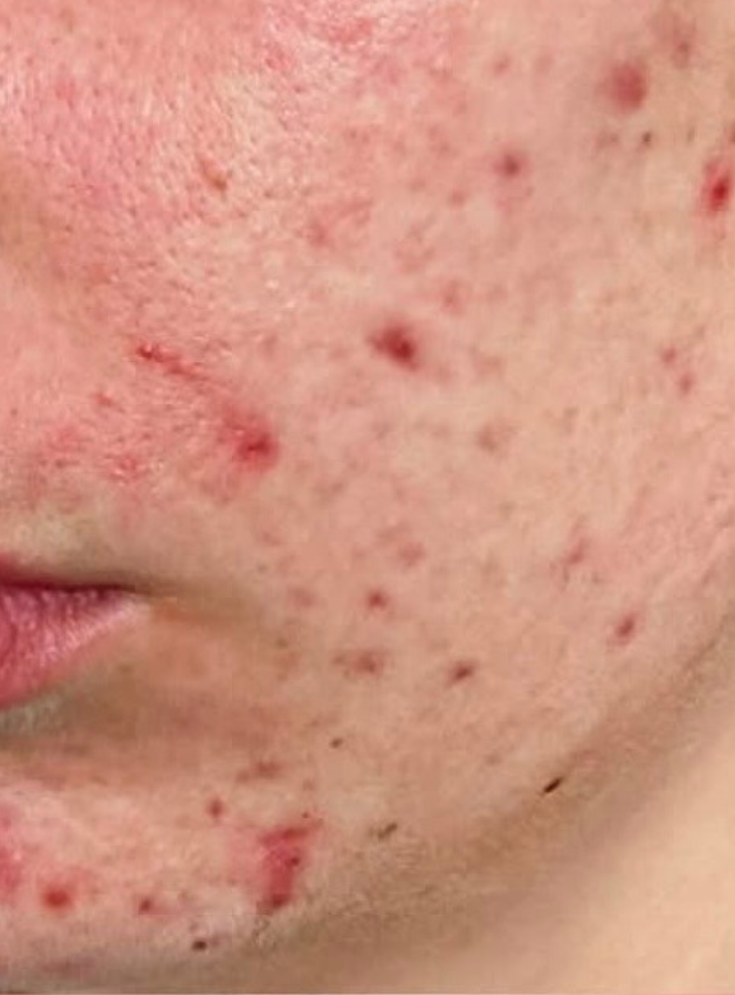Dermalux Flex MD 原廠頁刊載的藍光痘痘案例療程前照片
