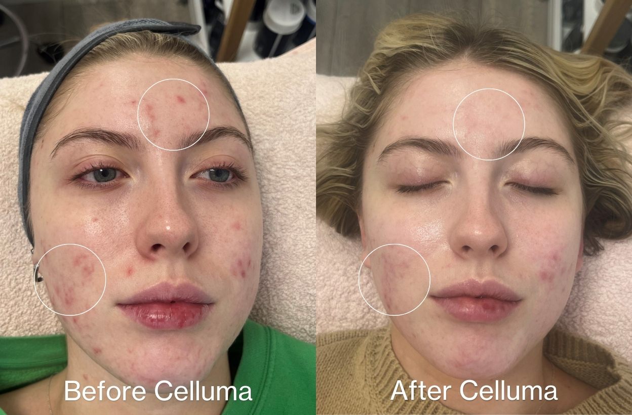 Celluma 官方案例:品牌頁列出每週三次、連續四週的藍紅光痘痘照光前後照
