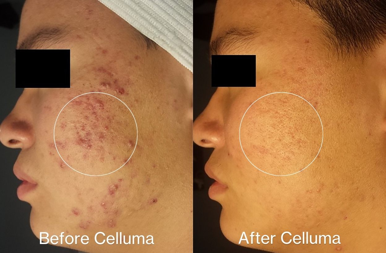 Celluma 官方案例:品牌頁列出每週兩次、連續八週的藍紅光痘痘照光前後照