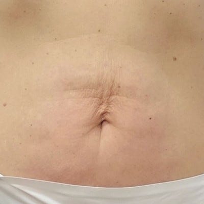 LPG 原廠腰腹個案,54 歲,十二次療程後照片