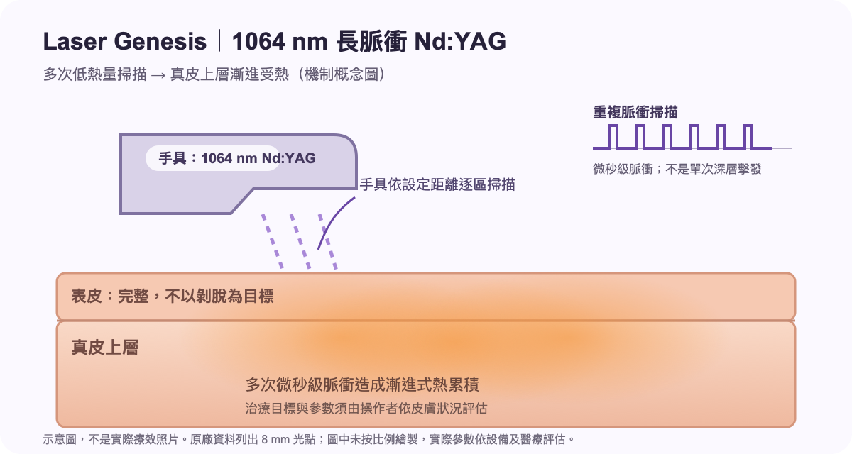 Laser Genesis 的 1064 nm 長脈衝雷射以多次低熱量掃描讓上層真皮漸進受熱;示意圖不是實際療效照片