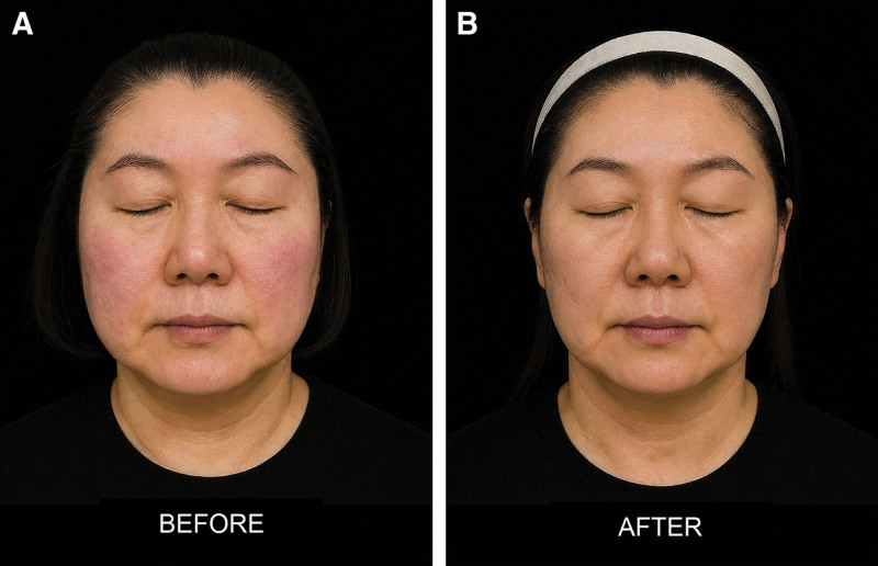 LinearZ 研究圖 6：49 歲女性治療前與 12 週後標準化正面照