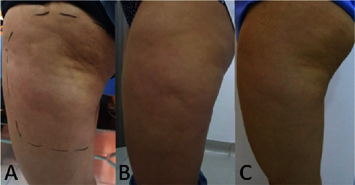 ONDA 微波研究 trochanteric skinfold 個案:治療前(A)、20 天後(B)及 3 個月後(C)