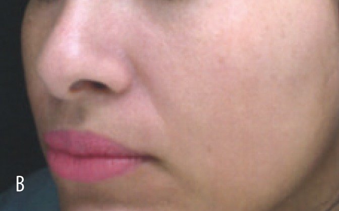 OxyGeneo 研究病例圖2B:完成第六次療程後的臉頰色素外觀,NeoRevive 組