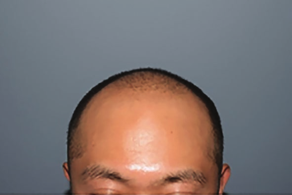 術前正面髮際與頭頂稀疏