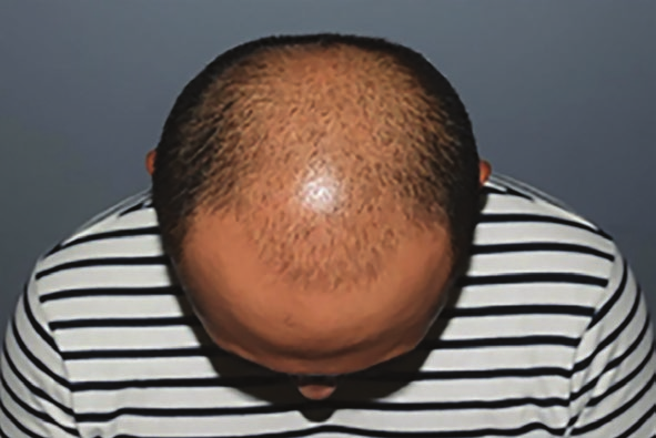 術前頭頂落髮範圍