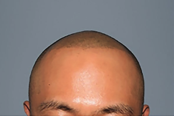 術後正面短髮視覺