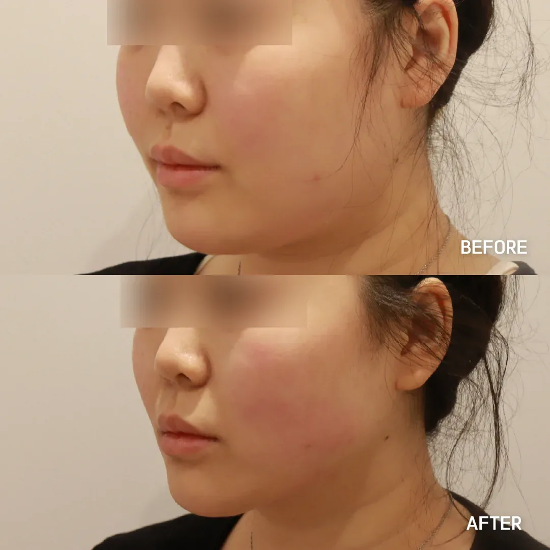 Shurink Universe 治療前後側面照,首爾 Dear Clinic 公開個案二
