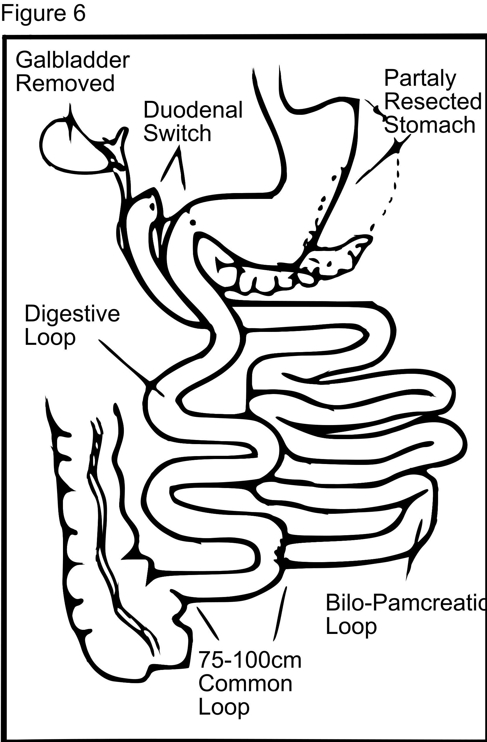 袖狀胃切除後胃部形狀改變示意