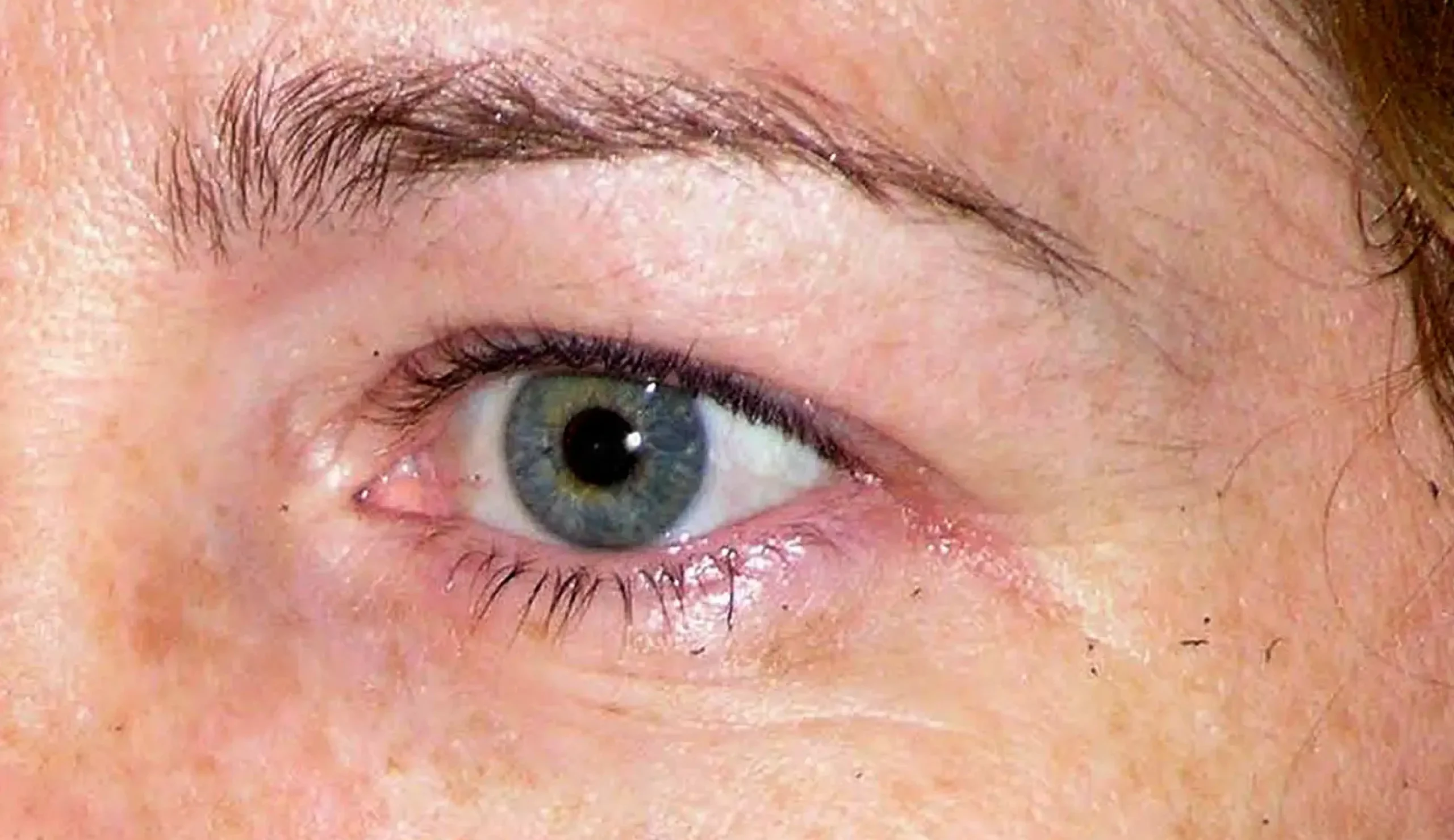 Thermage FLX 眼周療程前照片,原廠公開真人案例,已存入專案