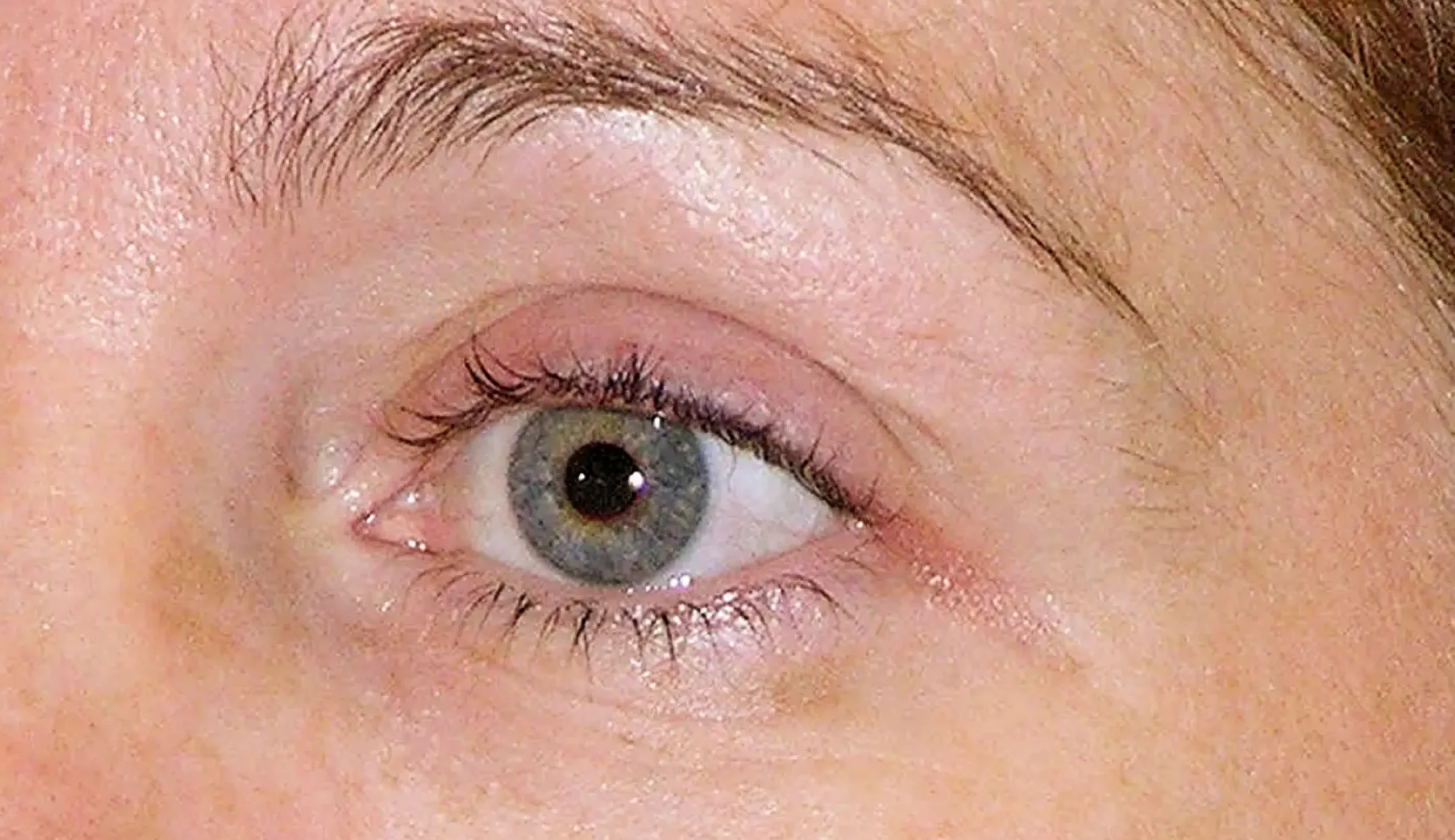 Thermage FLX 眼周單次治療後六週照片,原廠公開真人案例,已存入專案