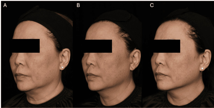 Ultherapy 病例實拍:MFU-V 治療後的下臉外觀追蹤;該個案在三個月時另接受羥基磷灰石鈣注射,不能把全部變化歸因於音波