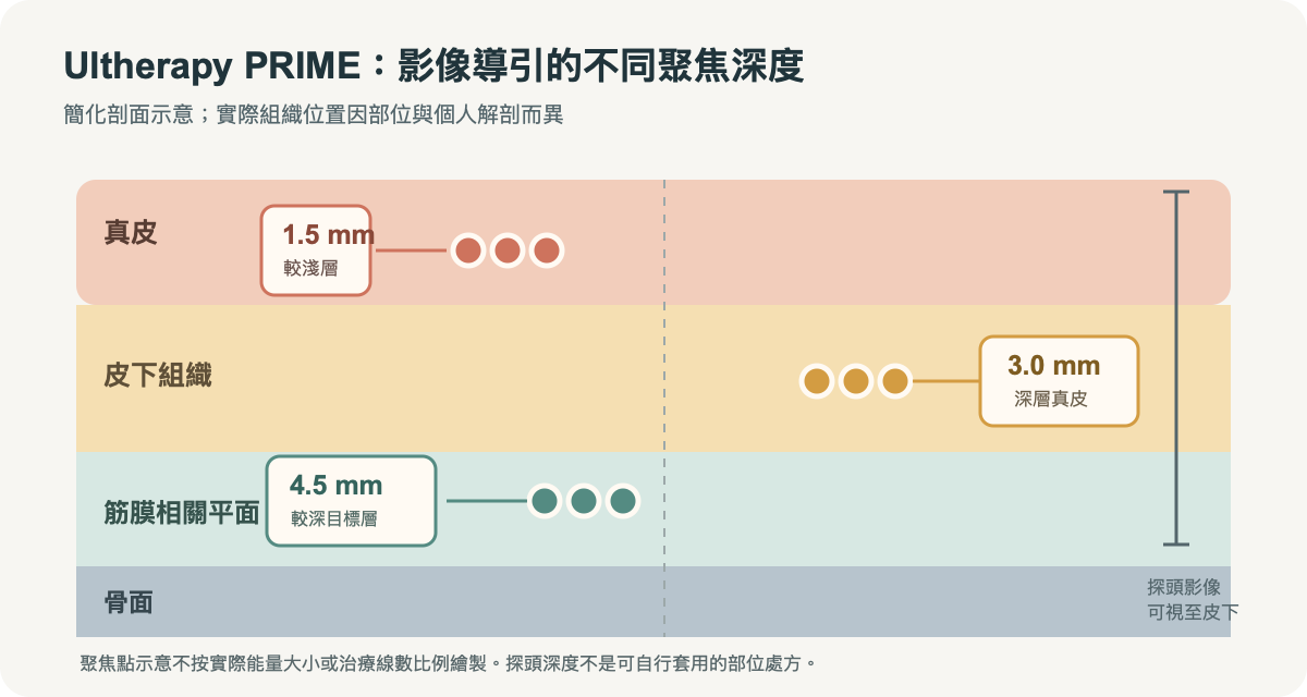 Ultherapy PRIME 三種常見治療深度示意:深度由醫師依超音波影像與部位組織選擇,不是每個人都要全層施作